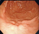 がん病変を確認