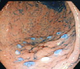 切除範囲確定のためのマーキング