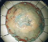 病理標本の摘出